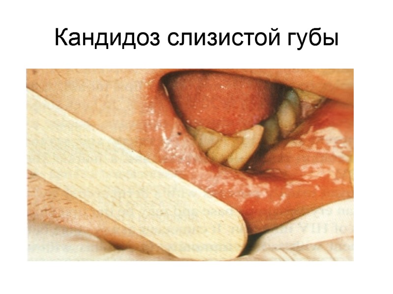 Кандидоз слизистой губы